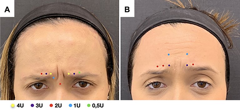Botulinum Toksin Botoks imajbet - Best Lasik